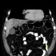 Varicose dilation of the biliary ducts in the left liver lobe, unknown origin: CT - Computed tomography